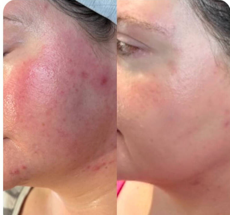 Gentle skin rejuvenation with Tixel technology